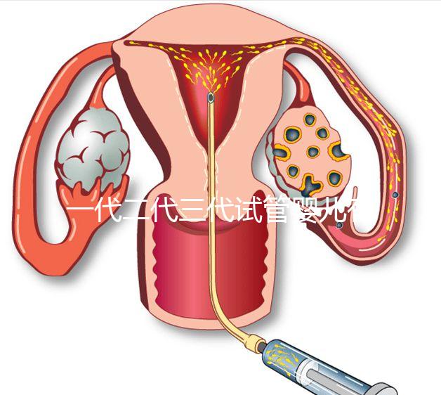 一代二代三代試管嬰兒有什么區別？