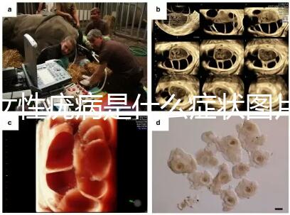 女性疣病是什么癥狀圖片（女生下面長(zhǎng)了疙瘩圖片）